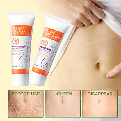 Stretch Mark Removal Cream for Postpartum Care