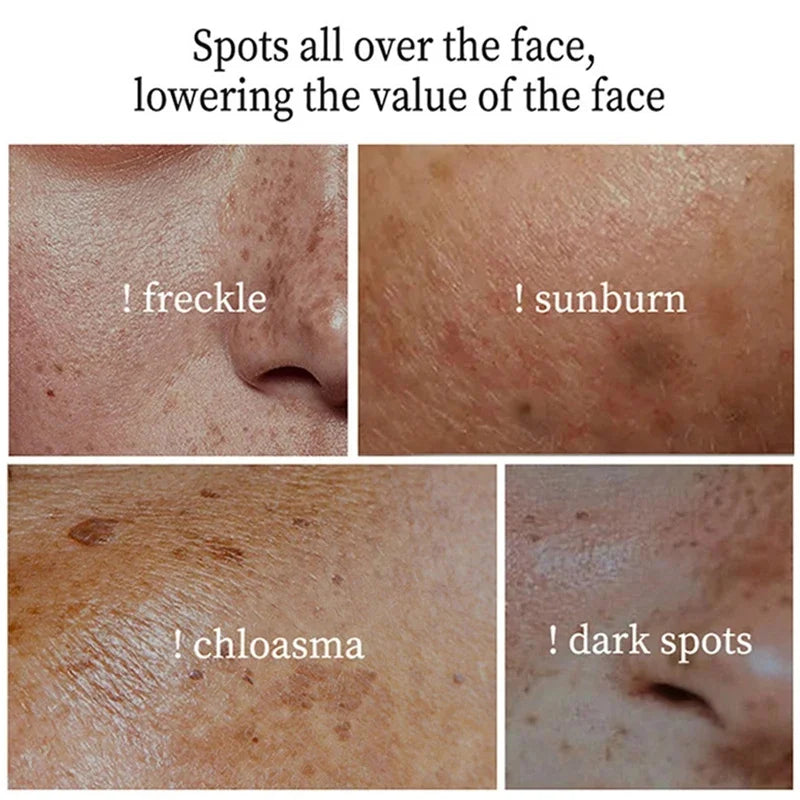 Effective Whitening Freckles Cream for Dark Spots