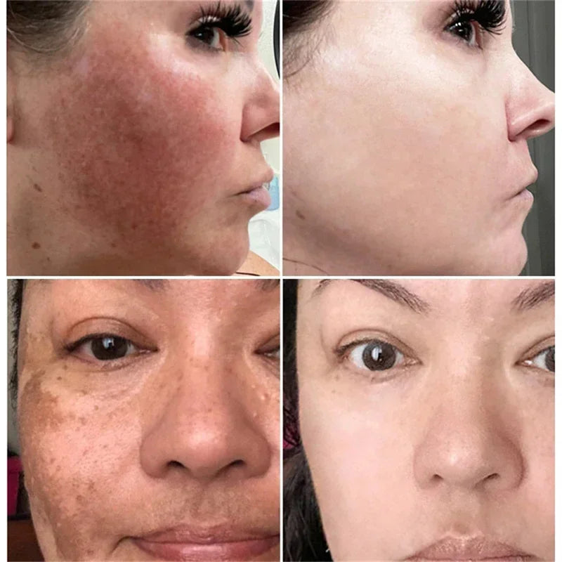 Effective Whitening Freckles Cream for Dark Spots