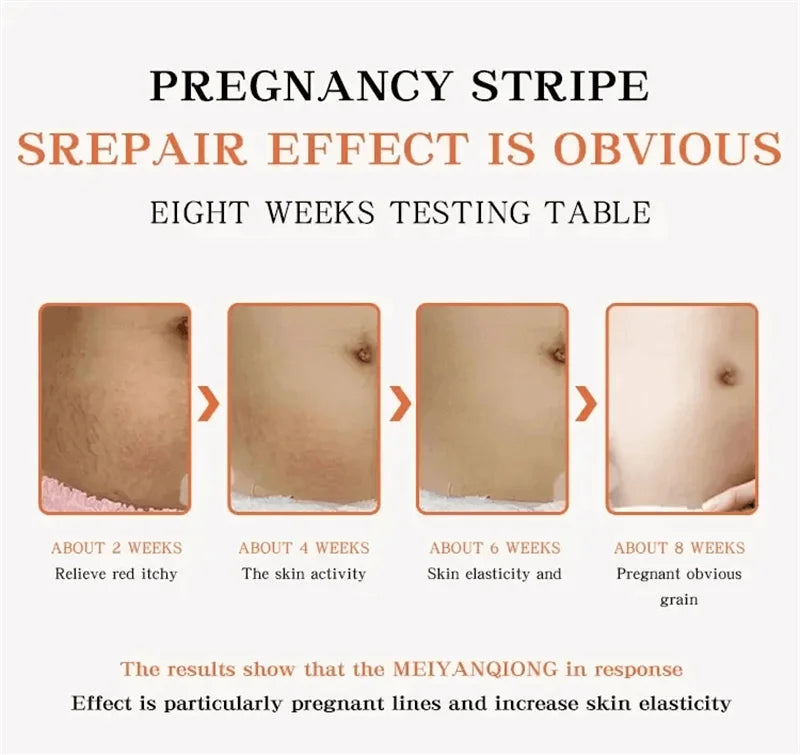 Stretch Marks Removal Cream for Maternity Care