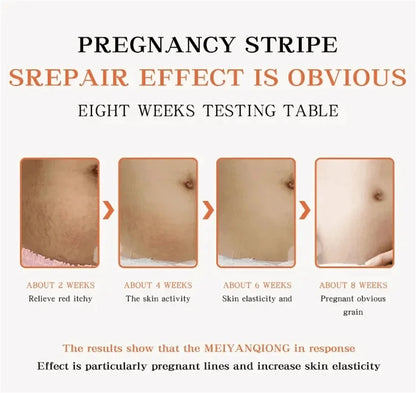 Stretch Marks Removal Cream for Maternity Care