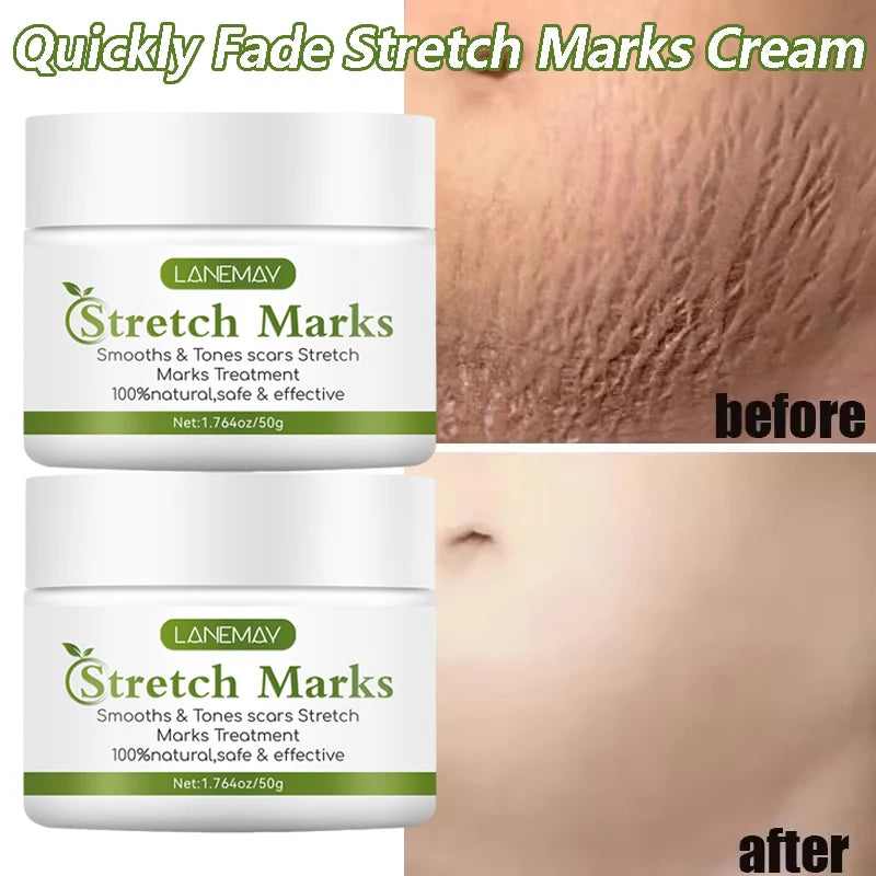 Stretch Marks Removal Cream for Maternity Care