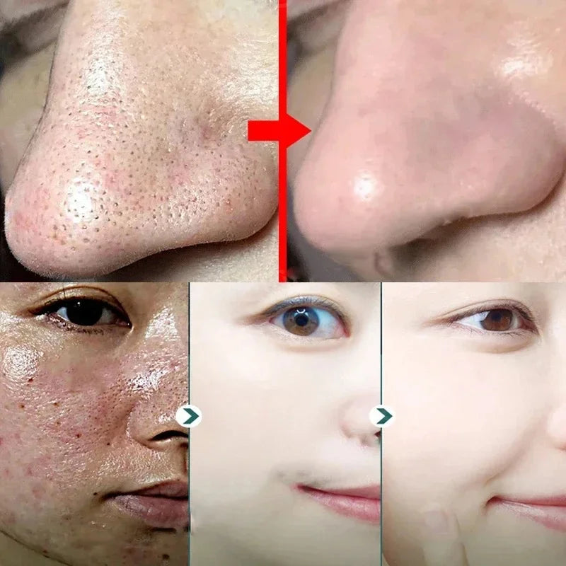 Green Tea Solid Mask for Acne and Blackhead Removal