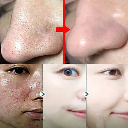 Green Tea Solid Mask for Acne and Blackhead Removal