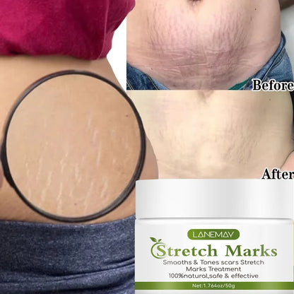 Stretch Marks Removal Cream for Maternity Care