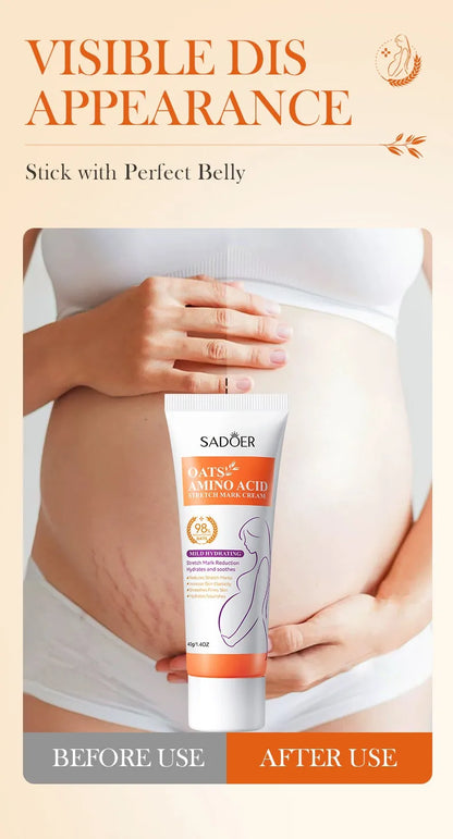Stretch Mark Removal Cream for Women
