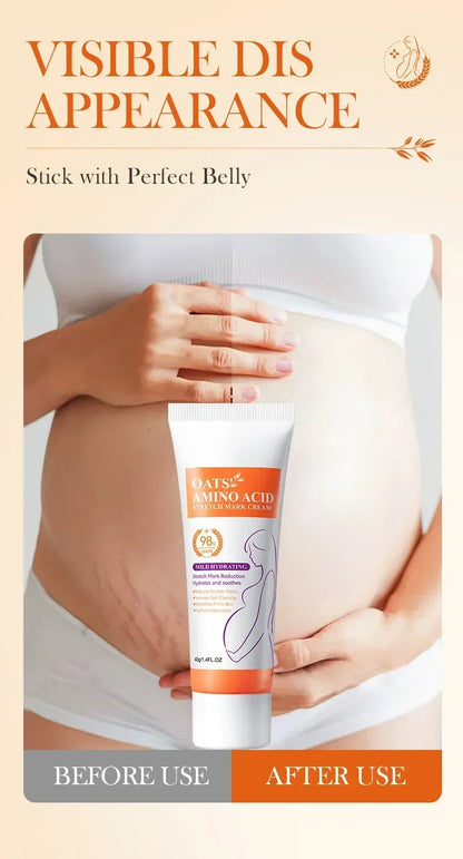 Stretch Mark Removal Cream for Postpartum Care