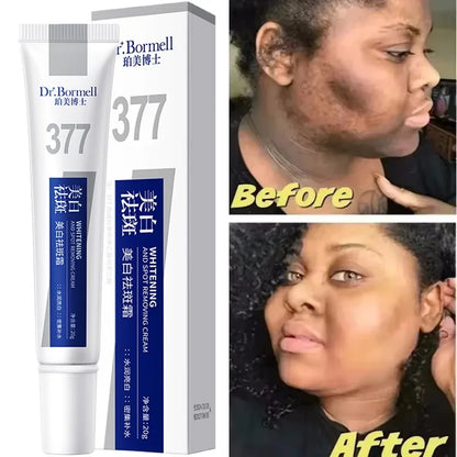 Effective Whitening Freckles Cream for Dark Spots