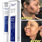 Effective Whitening Freckles Cream for Dark Spots
