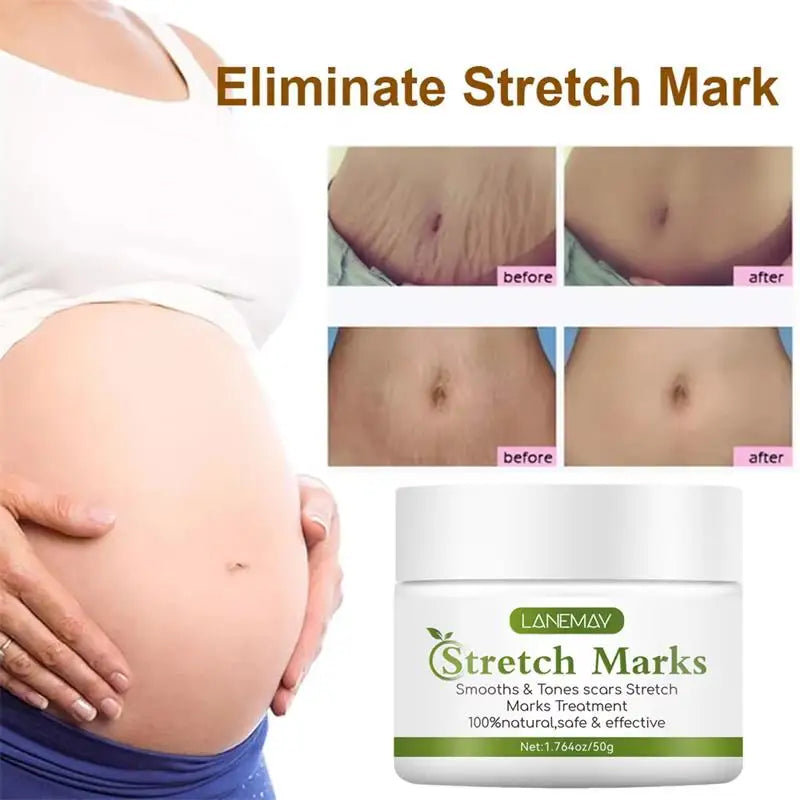 Stretch Marks Removal Cream for Maternity Care