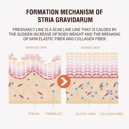 Stretch Marks Removal Cream for Maternity Care