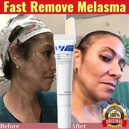 Effective Whitening Freckles Cream for Dark Spots