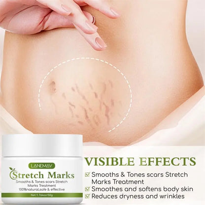 Stretch Marks Removal Cream for Maternity Care