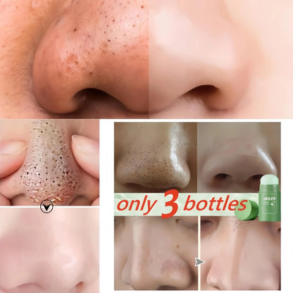 Green Tea Solid Mask for Acne and Blackhead Removal