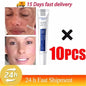 Effective Whitening Freckles Cream for Dark Spots