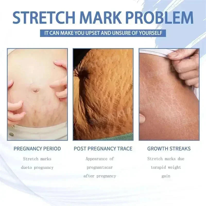 Stretch Mark Removal Cream for Postpartum Care