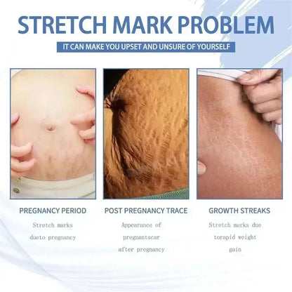 Stretch Mark Removal Cream for Postpartum Care
