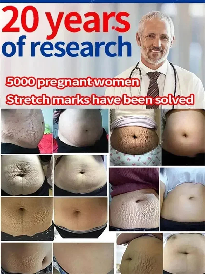 Stretch Mark Removal Cream for Postpartum Care