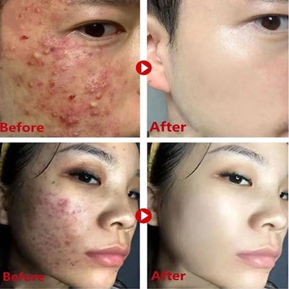 Green Tea Solid Mask for Acne and Blackhead Removal