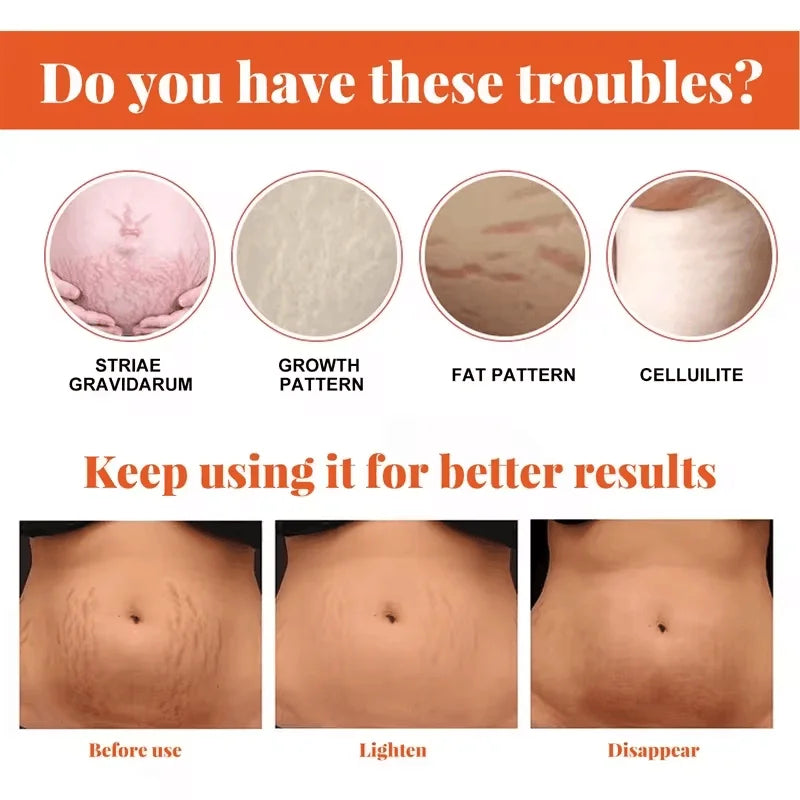 Stretch Marks Removal Cream for Maternity Care