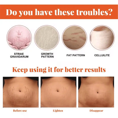Stretch Marks Removal Cream for Maternity Care