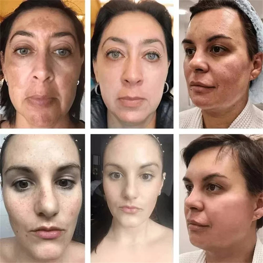 Effective Whitening Freckles Cream for Dark Spots