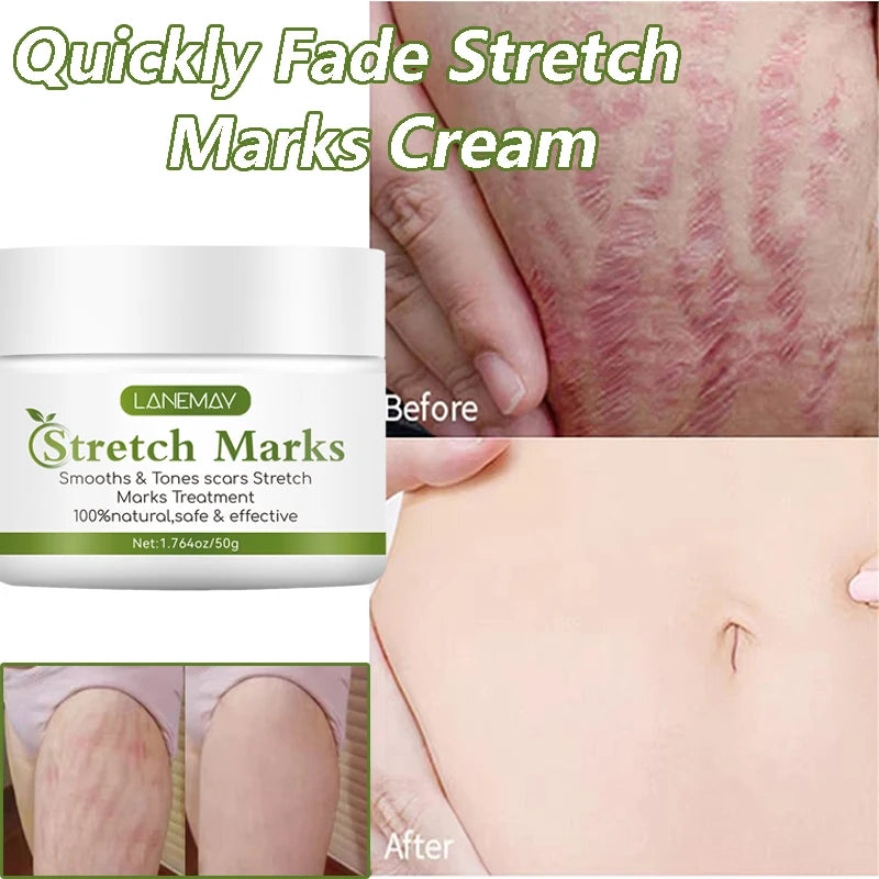 Stretch Marks Removal Cream for Maternity Care