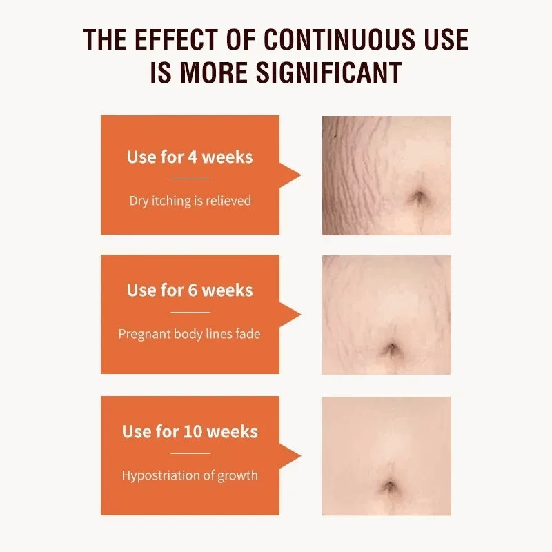 Stretch Marks Removal Cream for Maternity Care