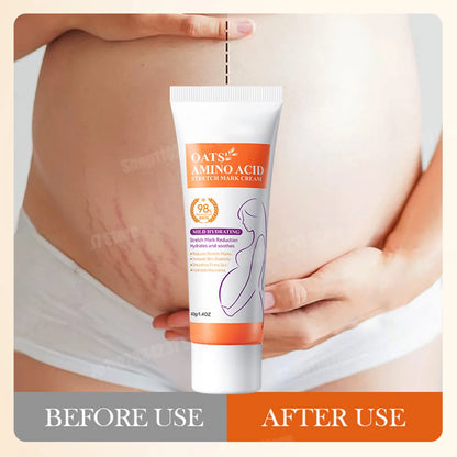 Stretch Mark Removal Cream for Postpartum Care