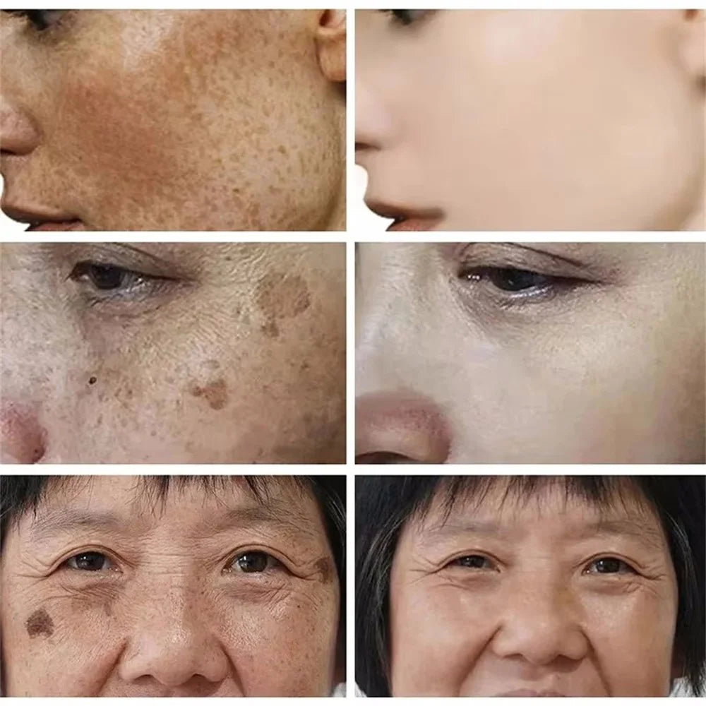 Effective Whitening Freckles Cream for Dark Spots