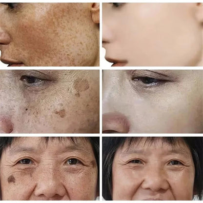 Effective Whitening Freckles Cream for Dark Spots