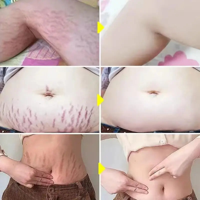 Stretch Marks Removal Cream for Maternity Care