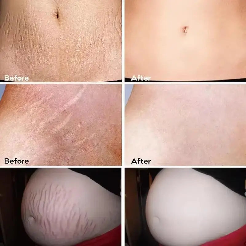 Stretch Marks Removal Cream for Maternity Care