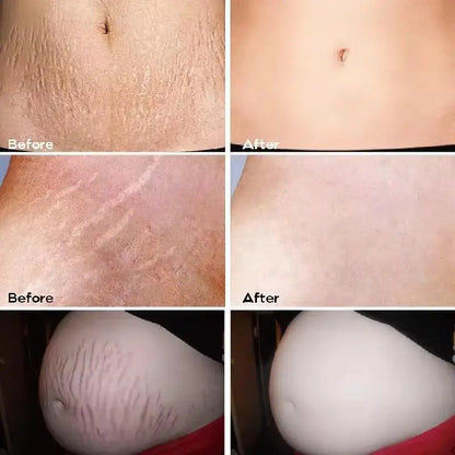 Stretch Marks Removal Cream for Maternity Care