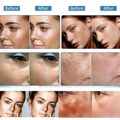 Nicotinamide Whitening Freckle Cream for Dark Spots
