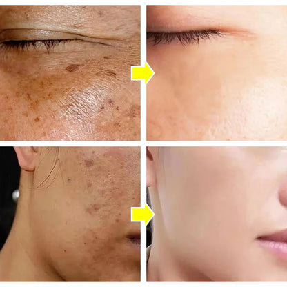 Nicotinamide Whitening Freckle Cream for Dark Spots