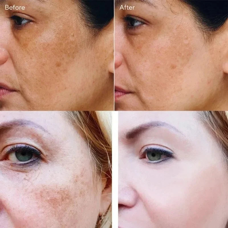 Nicotinamide Whitening Freckle Cream for Dark Spots