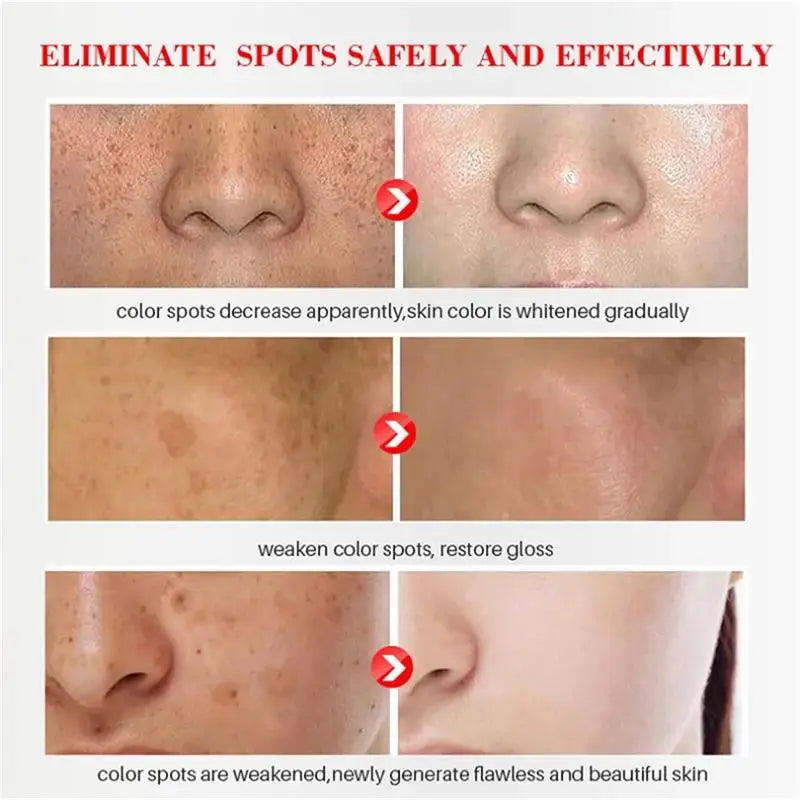 Nicotinamide Whitening Freckle Cream for Dark Spots